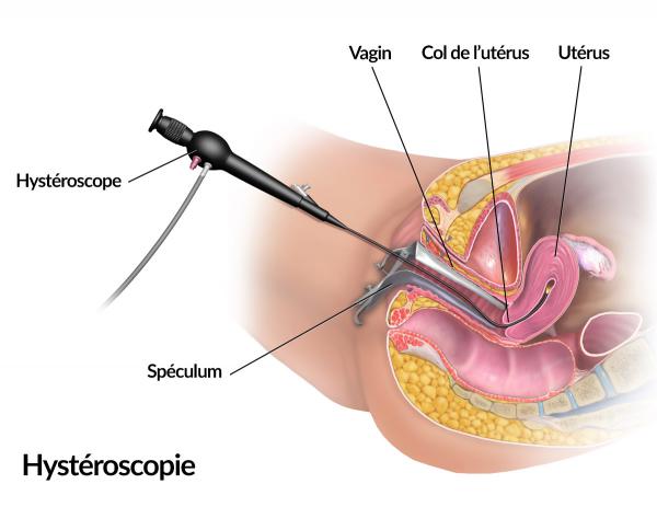 cardel turner recommends Internal Vagina Camera